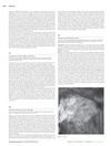 Infliximab-Associated Psoriasiform Alopecia