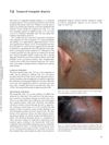 Temporal Triangular Alopecia