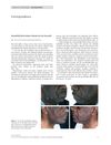 Pseudofolliculitis Barbae Induced by Oral Minoxidil