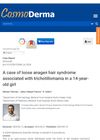 A Case of Loose Anagen Hair Syndrome Associated With Trichotillomania in a 14-Year-Old Girl