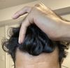 Pics before and after - 0.25 mg fin ED for 5 months. Advice on next steps?