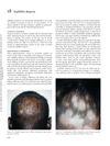 Syphilitic Alopecia: A Rare Manifestation of Secondary Syphilis