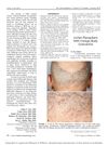 Lichen Planopilaris With Foreign-Body Granuloma