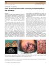 Case of Infective Endocarditis Caused by Implanted Artificial Hair Pyoderma