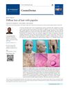 Diffuse Loss of Hair with Papules