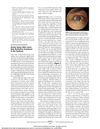 Ocular Injury After Laser Hair Reduction Treatment to the Eyebrow