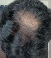 1 year on fin, before and after