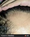 Minoxidl and Finasteride treatment journal
