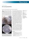 Hair Casts (Pseudonits) in a 9-Year-Old Girl