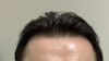 Seeking Advice on Starting Finasteride &amp; Minoxidil for Thinning Hair and Receding Sides