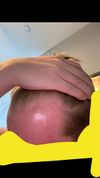 Balding at 19 and looking for guidance/tips