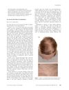 An Unusual Side Effect of Azathioprine