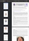 Scalp necrosis following hair transplantation successfully managed with conservative wound care and adjunctive photobiomodulation: A case report
