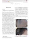 Spontaneous Hair Regrowth in Eight Patients with Severe Alopecia Areata