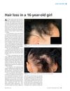 Hair Loss in a 16-Year-Old Girl: A Case Study