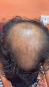 Male 23, severe hairloss from last couple of years got depressed stop taking anything for last 1 years what should i do, transplant an o only option?