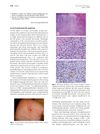 Acral Lymphomatoid Papulosis in a 31-Year-Old Woman