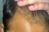5 Months on Topical Min/Fin – Are These Baby Hairs or Just Thin Hairs?