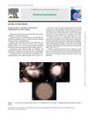 Alopecia Areata: A Possible Extraintestinal Manifestation of Crohn's Disease