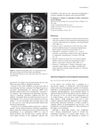 Abnormal Fingerprints and Immigration Delay Disease