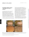 Aromatase Inhibitors Induce Male Pattern Hair Loss in Women