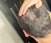 17M Seeking Advice: Is It Too Late to Start Hair Loss Treatment?