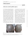 Moth-Eaten Essential Syphilitic Alopecia