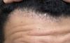 Is Topical Finasteride Effective for My Receding Hairline?