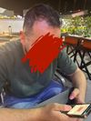 What should I do? Hair transplant OR Minoxidil?