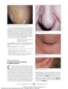 Hair Casts and Cutaneous Spicules in Multiple Myeloma