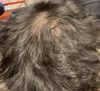 1years finasteride and 10 month oral min 5mg