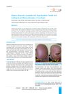 Alopecia Universalis Associated With Hyperthyroidism Treated With Azathioprine And Hydroxychloroquine: A Case Report