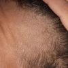 30M Considering Switching to Oral Minoxidil After 2-Month Topical Use on Temples
