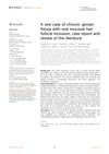 A Rare Case of Chronic Genian Fistula with Oral Mucosal Hair Follicle Inclusion: Case Report and Review of the Literature