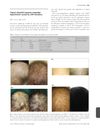 Topical Minoxidil Improves Congenital Hypotrichosis Caused by LIPH Mutations