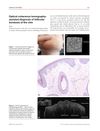 Optical Coherence Tomography-Assisted Diagnosis of Follicular Keratosis of the Chin