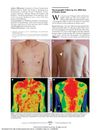 Thermographic Follow-Up of a Mild Case of Herpes Zoster