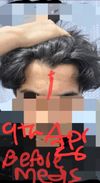 Months on finasteride 1mg + topical minoxidil 5%: how should I assess the apparent density change?