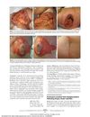 Permanent Localized Hair Repigmentation Following Herpes Zoster Infection