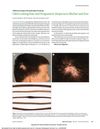 Odd-Looking Hair and Progressive Alopecia in Mother and Son