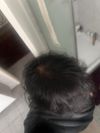 Advice on Crown Hair Loss and Frizziness at 31