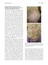 Telogen Effluvium Associated with the Dopamine Agonist Pramipexole in a 55-Year-Old Woman with Parkinson's Disease
