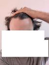 33M - Should I stick with topical finasteride or switch to oral?