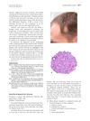 Fixed Focal Alopecia for 20 Years