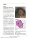 Alopecia Following Deoxycholic Acid Treatment for Submental Adiposity