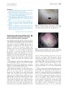 Trichoscopy of Dissecting Cellulitis of the Scalp: Exclamation Mark Hairs and White Dots as Markers of Disease Chronicity