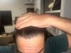 Should I start taking finasteride?( 18.5 male)