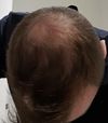 Should I HT or continue more time on fin and add in minoxidil first?