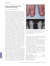 Psoriatic Onychopachydermoperiostitis: Improvement with Etanercept