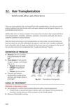 Hair Transplantation